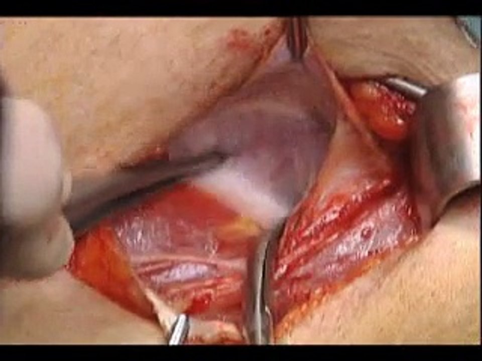 Tension Free Open Inguinal Hernia Repair | Hernia Treatments in Pune - JT Obesity Solutions