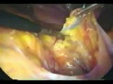 Histeropexia con prótesis