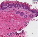 Histopathology Skin--Lamellar ichthyosis