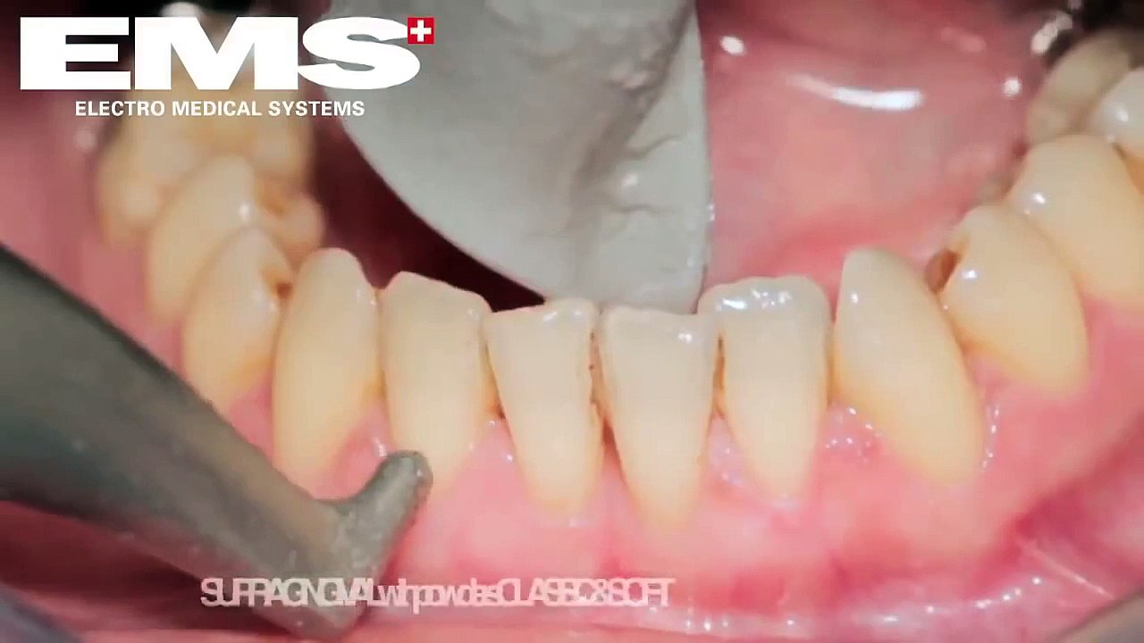 NHS Dentist  EMS Airflow (TM)Cleaning