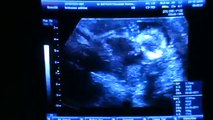 Echographie du foetus à 4 mois