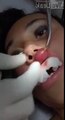 Une femme se fait retirer une larve de sa lèvre