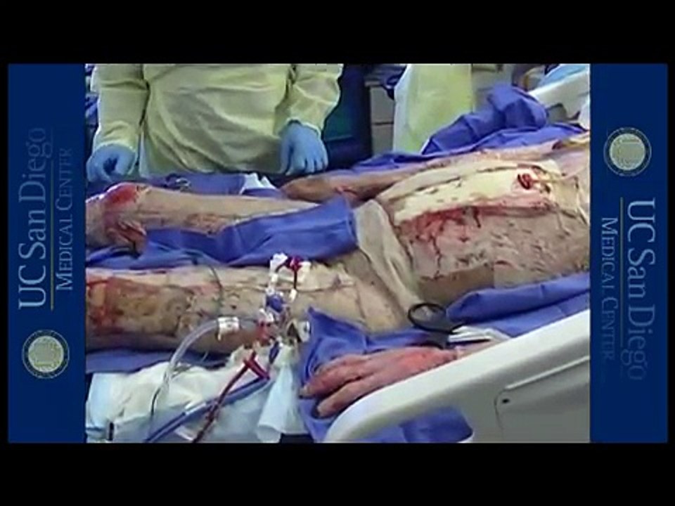 Dressing Change - Burn Patients