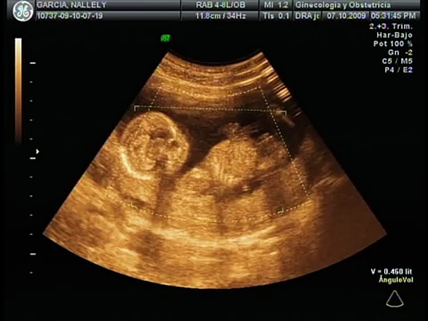 Ecografia 4d De Edgar Yhadiel En Mis 3 Meses Y Medio De Embarazo Video Dailymotion