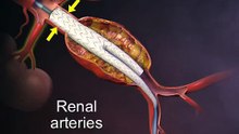 Endovascular Graft in an Abdominal Aortic Aneurysm