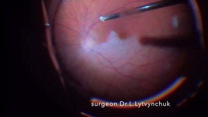 Surgical Embolectomy for Branch Retinal Artery Occlusion Lyubomyr Lytvynchuk