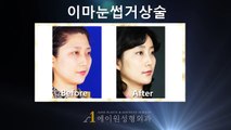 (Korea) Aone Plastic Surgery before & after [ endoforehead-brow lift ]