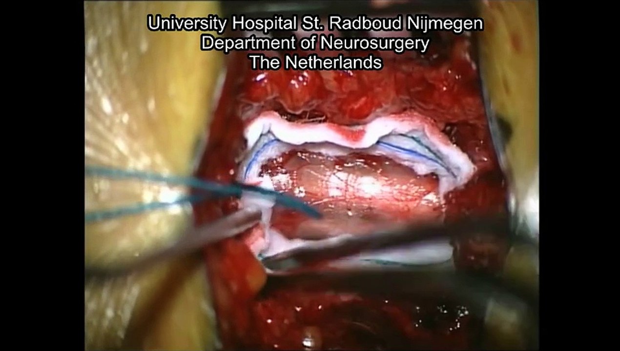 Tethered Spinal Cord with Lipoma of the Filum Terminale
