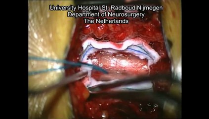 Tethered Spinal Cord with Lipoma of the Filum Terminale