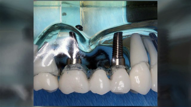 3 Questions to Ask Yourself About Dental Implants