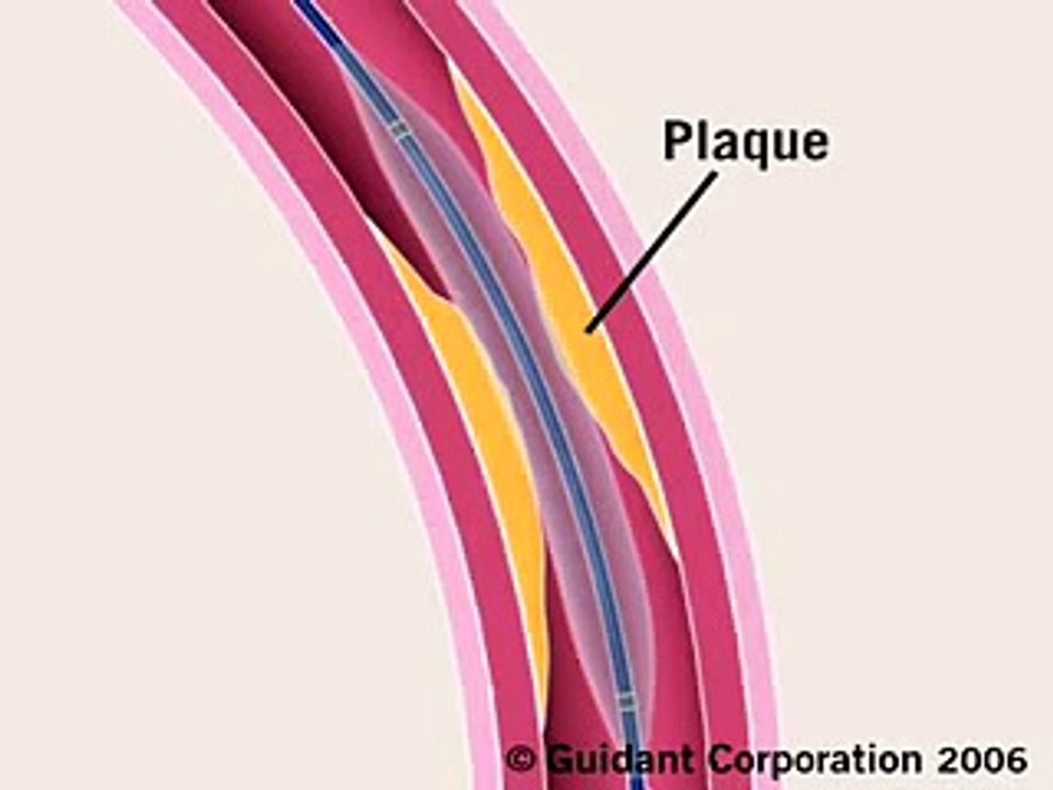 Angioplasty