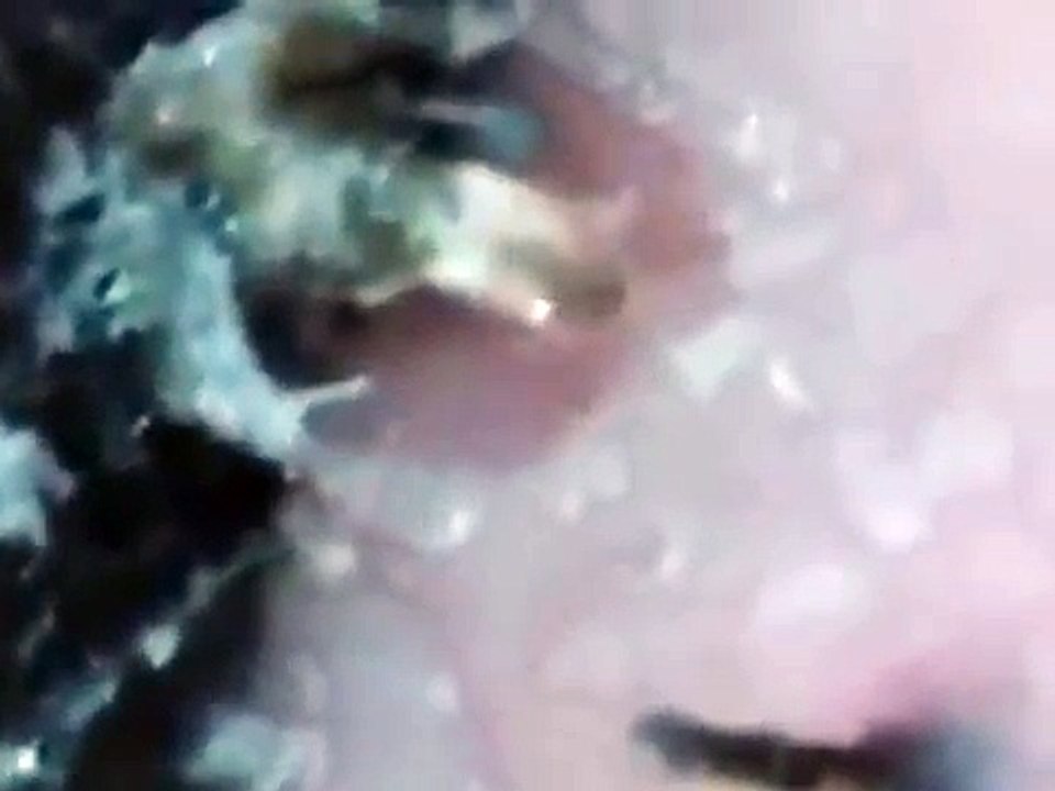 What long blackheads