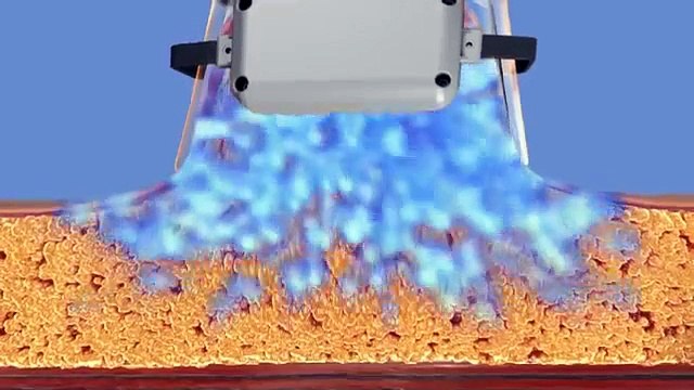 CoolSculpting Fat Reduction - How it Works