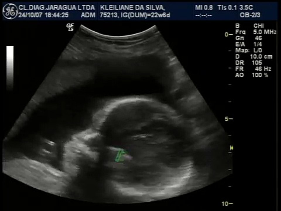 ultrason 6 meses da Polliana