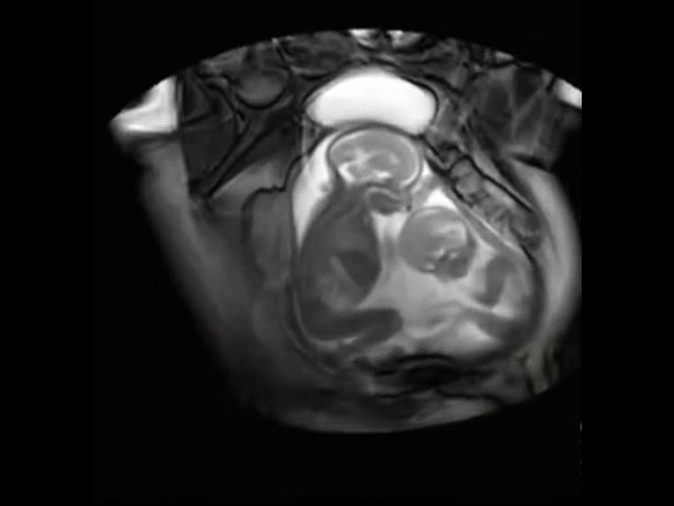 Twins Fighting Inside Womb; AMAZING