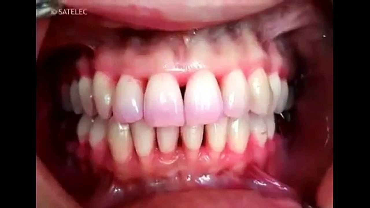 Teeth Scaling Procedure
