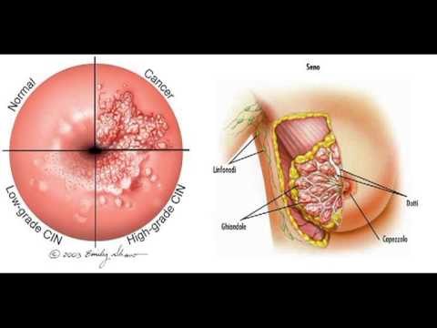 Lajme - Dita kundër kancerit të gjirit