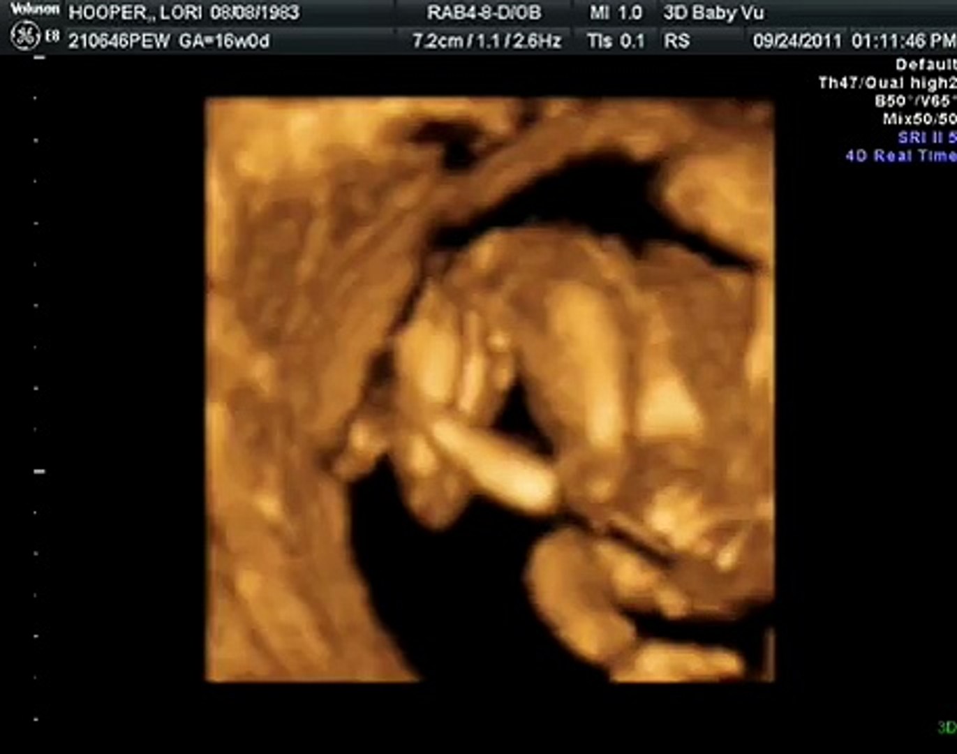 16 Week Ultrasound Gender Determination Video Dailymotion