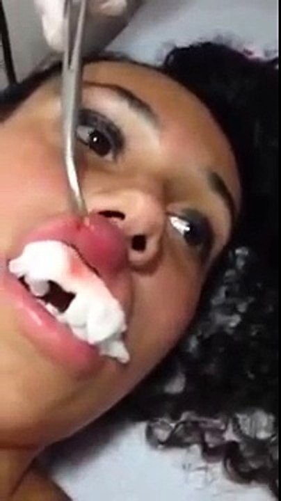 Girl Has Large Worm Larvae Pulled From Lips