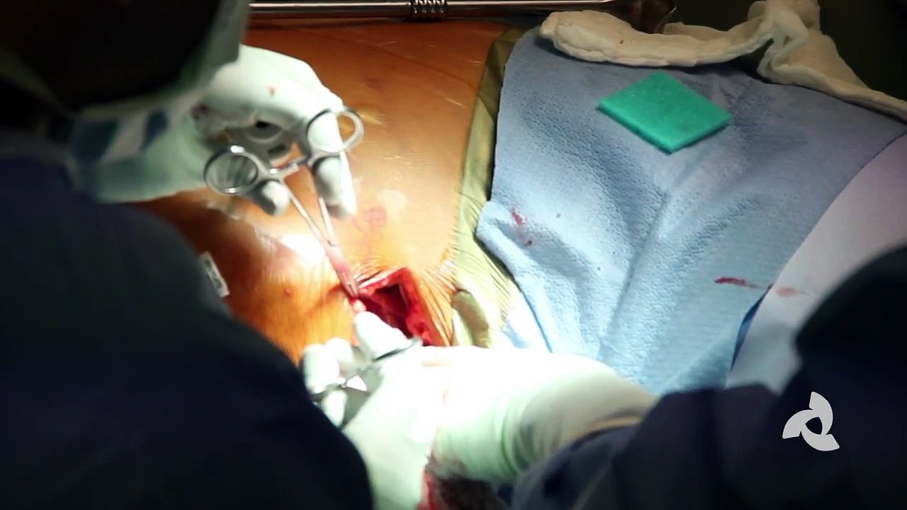 Living Donor Kidney Transplant Surgery