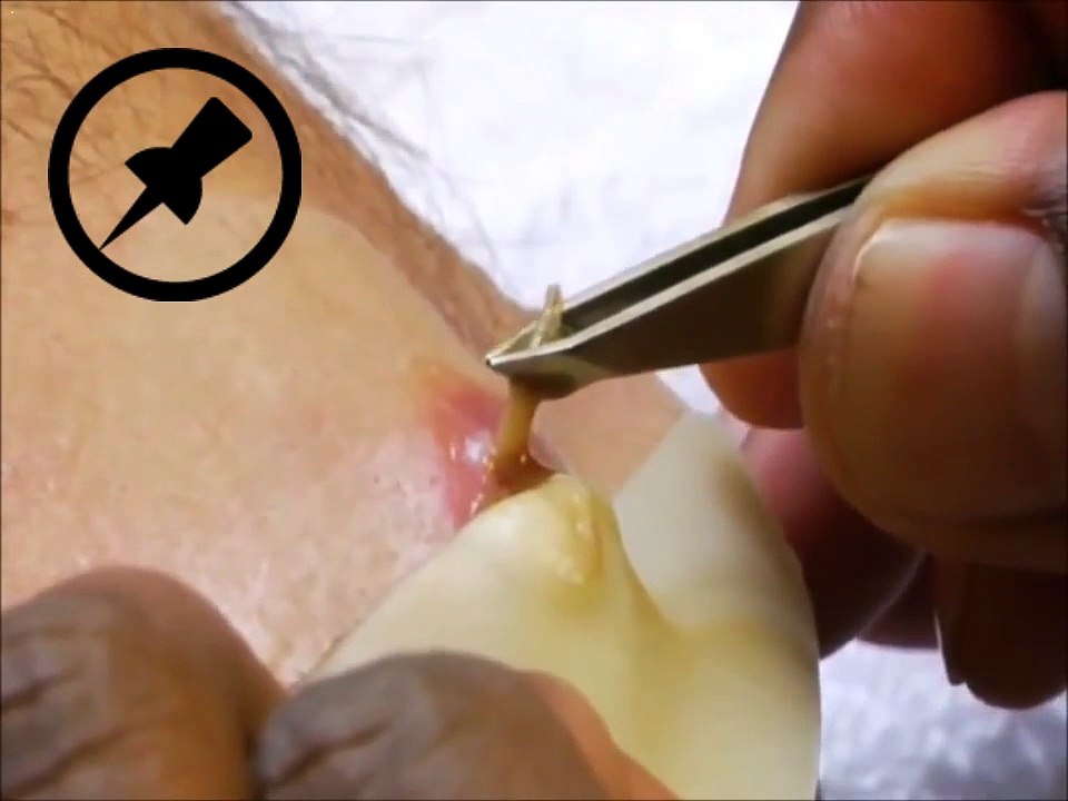 Botfly Removal1