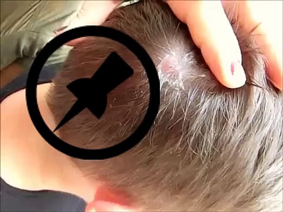 Huge Botfly Maggot Removed from Head1