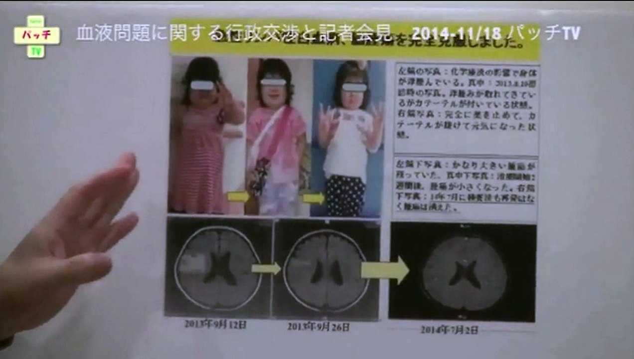 急性白血病の治療！！