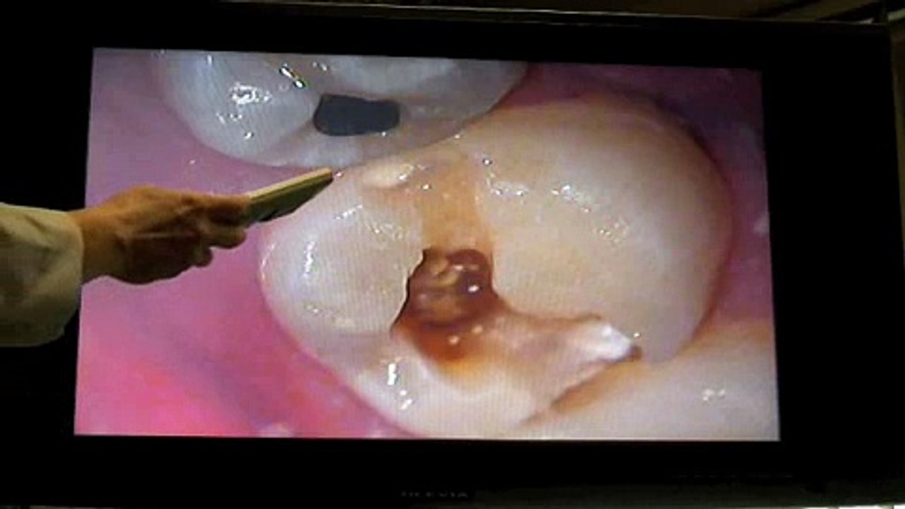 filling 2parts