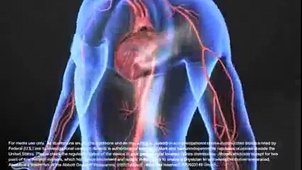 Simulacion  Stent Coronario Biorreabsorbible Absorb de Abbott Vascular