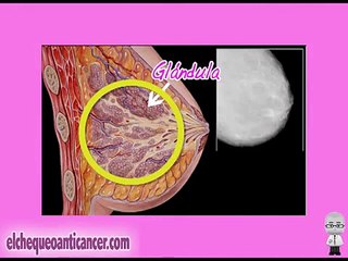 Cáncer de Mama - Cómo explorarse