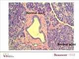 Pathology of Pancreatic Cysts, Precursor Lesions & Pancreatic Cancer