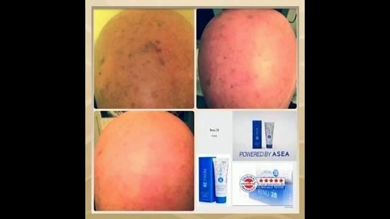 ASEA Renu 28 Before/After Photos
