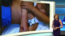 8-year old boy undergoes surgery after dog attack