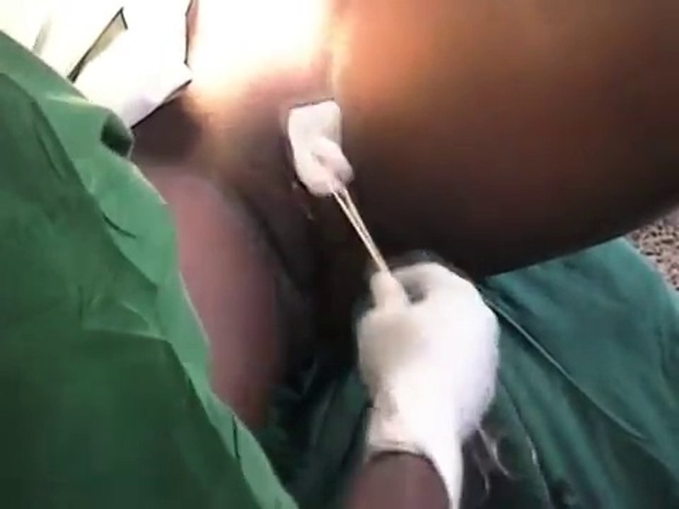 Total Abdominal Hysterectomy Catheterisation