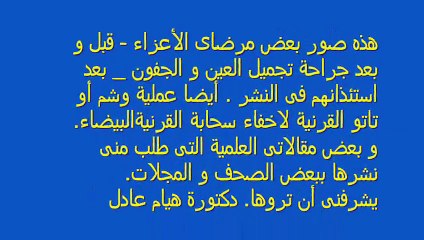 plastic eyelid   1-د. هيام عادل استشارى جراحات تجميل الجفون و تاتو سحابة القرنية