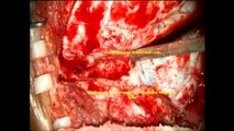 MELANOMA  MALIGNANT BRAIN-skull base-paracavernous sinus--microsurgery-dr suresh dugani/HUBLI//INDIA
