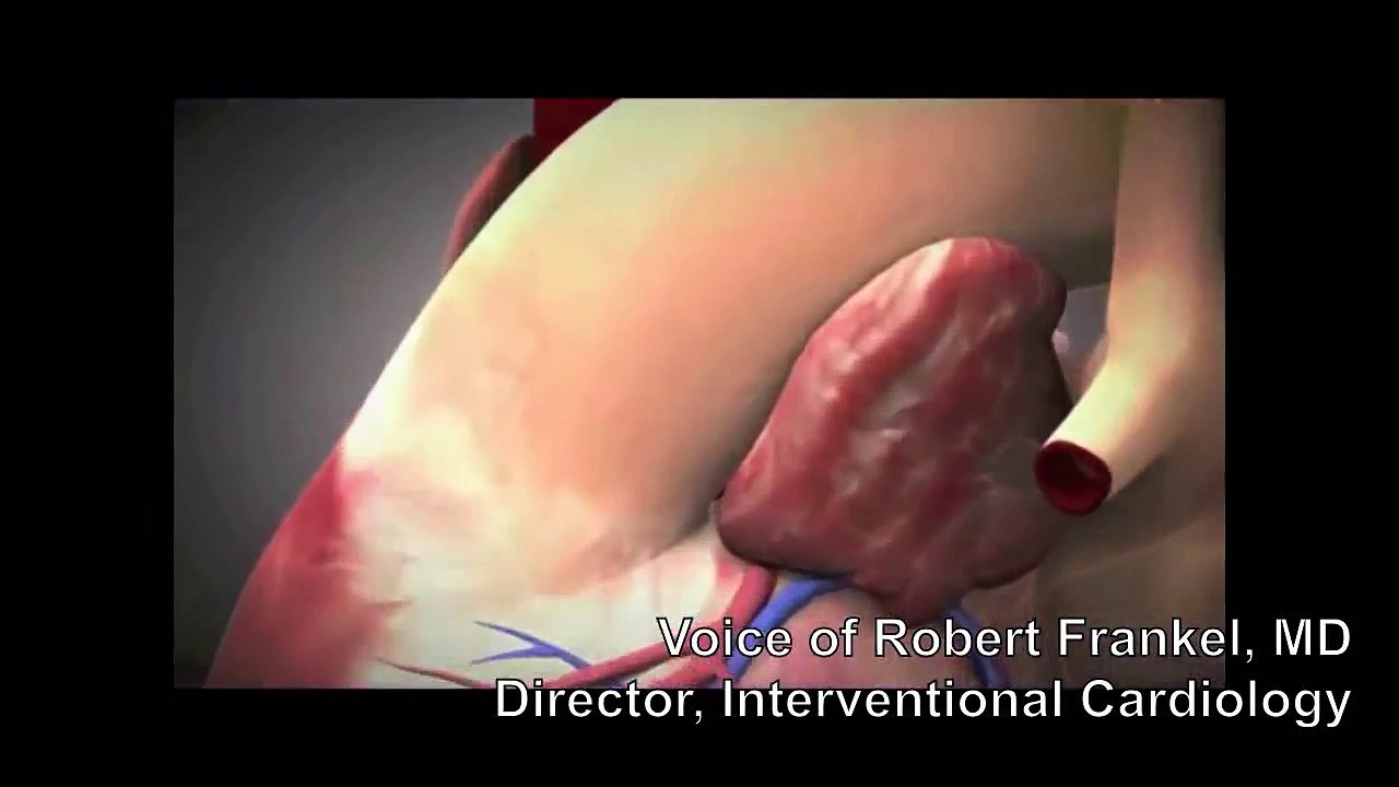Transcatheter Aortic Valve Implantation (TAVI)