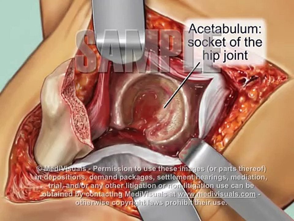 Total Hip Replacement Surgery: Medical Animation