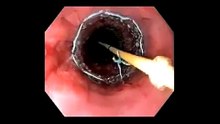WallFlex® Partially Covered Esophageal Stent Placement - Dr. Gerke