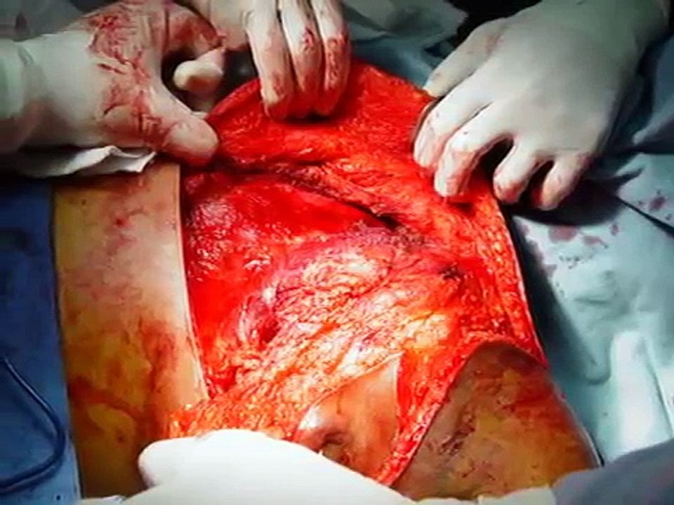 Tumor de hueso. Condrosarcoma.
