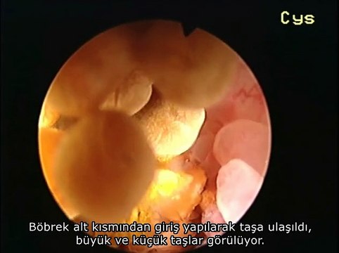 Kapalı (Sağ Perkütan) Böbrek Taşı Ameliyatı - Üroloji İstanbul