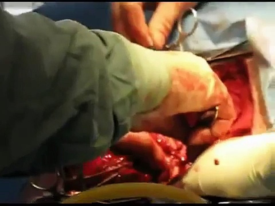 Removal of Giant Kidney Worms from Dog
