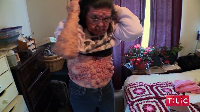Bubble Gran, Woman Covered In Benign Tumours: Body Bizarre Episode 5