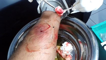 Neverending Puss Flows From This Man's Leg