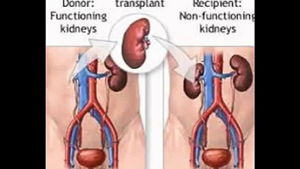 Kidney Transplant Surgery India