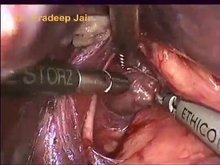 Dr Pradeep Jain - ESOPHAGUS - Laparoscopic Nissen's Fundoplication