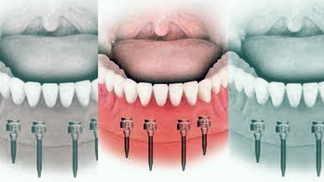 Mini Implants in Glasgow