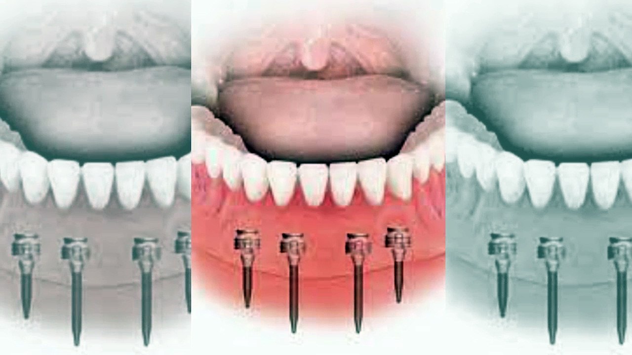 Mini Implants in Glasgow