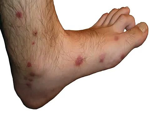 Remedios caseros para las picaduras de mosquitos