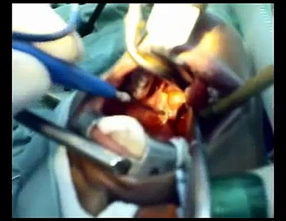 tonsillectomy